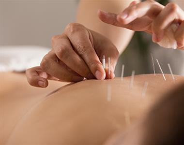 Acupuncture Photo